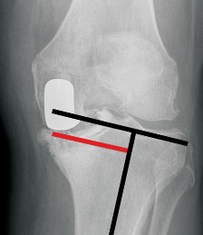Understand Augments: The Role of Metal Augments in Arthroplasty