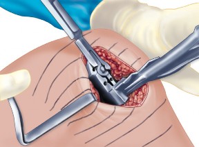 Illustration 62 for Unicompartmental Knee Arthroplasty: Master decisions with this b c figure guide.