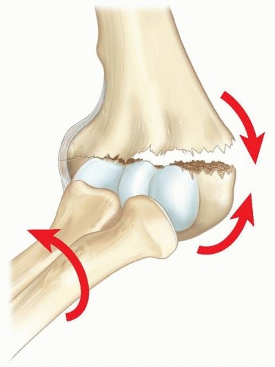 Closed Reduction and Percutaneous Pinning of Supracondylar Fractures of the Humerus