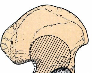 Acetabulum Posterior Approach: Simplest Fix for Hip Fractures