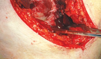 Illustration 39 for Unlock the Figure Posterior Approach to the Hip