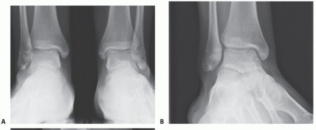 Painful Talus Lesions? The tech fig c Osteochondral Transfer Solution