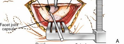 Illustration of spine posterior approach - Dr. Mohammed Hutaif
