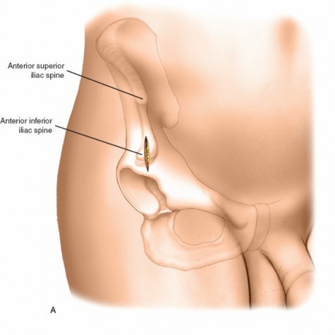 Illustration 22 for Expert Guide: Ulna and Wrist External Fixation Pin Placement