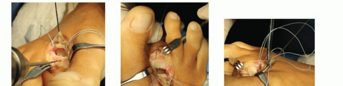 Illustration 40 for Plantar Plate Repair: End Lesser Toe Pain & Instability