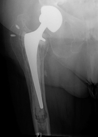 Illustration of open reduction internal - Dr. Mohammed Hutaif