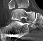 Illustration 10 for Decoding Pilon Fractures: Anterolateral and Medial Fragments Revealed