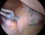 Regain Stability: Anterior Shoulder Instability Arthroscopic Fix