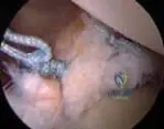 Illustration of anterior shoulder instability arthroscopic - Dr. Mohammed Hutaif
