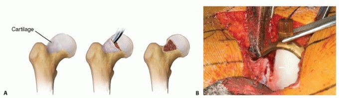 Illustration 16 for Surgical Hip Dislocation Safety: The Branch of the MFCA's Vital Role