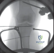 Illustration of plateau fractures lateral - Dr. Mohammed Hutaif