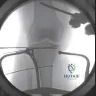 Illustration of plateau fractures lateral - Dr. Mohammed Hutaif
