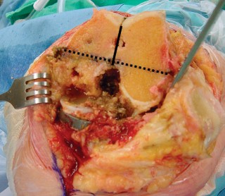 Illustration 24 for Revision of Failed UKA: Your Guide to Successful Treatment