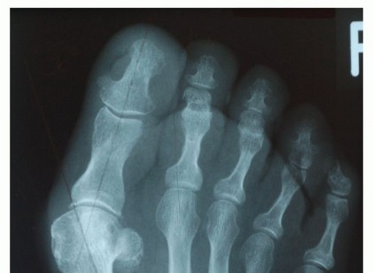 Distal Chevron Osteotomy: Mastering Lateral Soft Tissue Release