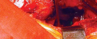 Illustration 25 for Posterolateral Surgical Approaches: Achieve Optimal Hip Replacement