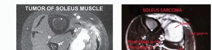 صورة توضيحية لـ استئصال ورم العضلة النعلية: دليل شامل لحماية عضلة الساق والتعافي الكامل في صنعاء مع الأستاذ الدكتور محمد هطيف