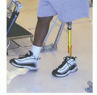 صورة طبية: استئصال مفصل الورك: دليل شامل للمرضى مع الأستاذ الدكتور محمد هطيف