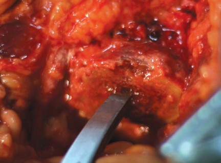 صورة طبية: مفصل الفخذ الصناعي قصير الجذع METHA: حلول مبتكرة للحفاظ على العظم في صنعاء مع الأستاذ الدكتور محمد هطيف