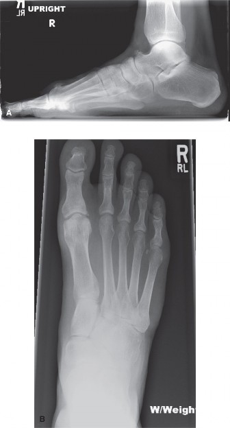 Unlock Motion: Improve Degrees of Dorsiflexion for Big Toe Pain