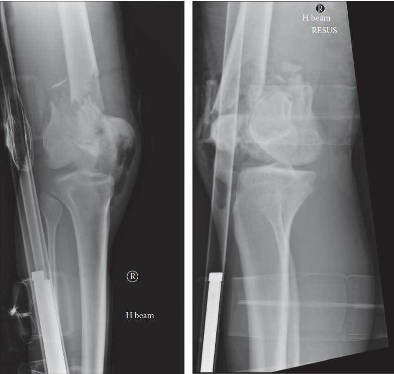 Critical Distal Femoral Fracture: Urgent Care & Surgical Guide