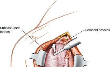 Illustration 31 for Essential Guide: Mastering Every Approach to the Shoulder