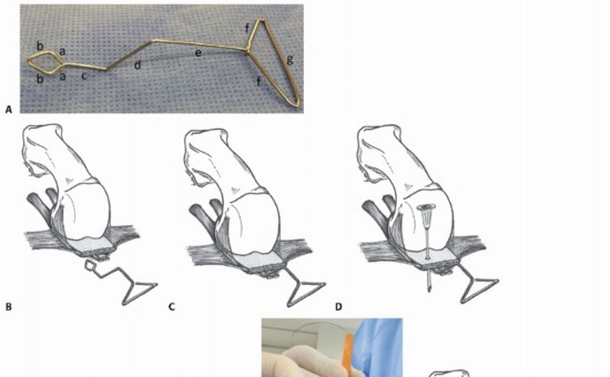 Illustration 23 for Plantar Plate Repair: End Lesser Toe Pain & Instability