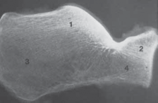 Illustration of extensile lateral approach - Dr. Mohammed Hutaif