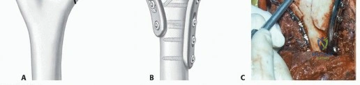 Illustration 12 for Optimizing ORIF for Distal Humerus: Prevent Class II HO