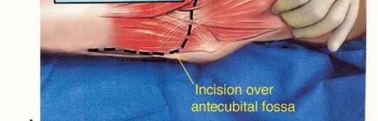 صورة توضيحية لـ استئصال الجزء البعيد من عظم العضد: تقنيات آمنة للحفاظ على الطرف في صنعاء مع الأستاذ الدكتور محمد هطيف