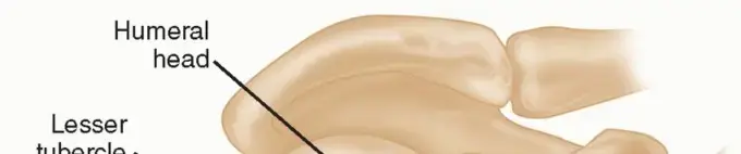 صورة توضيحية لـ كسور عظم العضد القريب: دليل شامل للمرضى لاستعادة حركة الكتف مع الأستاذ الدكتور محمد هطيف