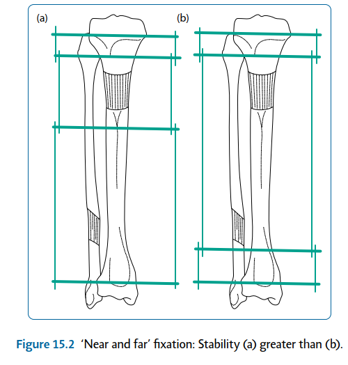 Illustration 2 for Limb Reconstruction: Restoring Function for Challenges Near and Far