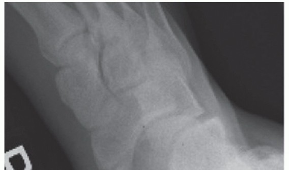 Accessory Navicular Pain? Explore the Modified Kidner Procedure