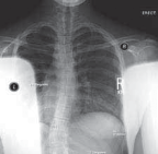 Mastering Anterior Interbody Arthrodesis with Instrumentation for Scoliosis