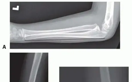إعادة بناء وعلاج كسر مونتيجيا المزمن (المهمل) لدى الأطفال والكبار: دليلك الشامل للتعافي