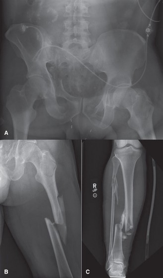 Illustration of damage control orthopaedics - Dr. Mohammed Hutaif
