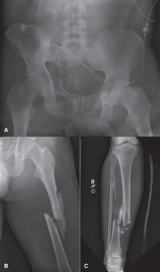 صورة توضيحية لـ جراحة التحكم بالضرر في العظام: نهج إنقاذ الحياة لاستعادة التعافي من الإصابات المعقدة