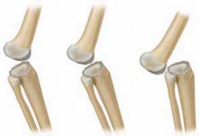 Mastering the Surgical Repair of Irreducible Knee Dislocation