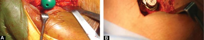 صورة طبية: مفصل الفخذ الصناعي قصير الجذع METHA: حلول مبتكرة للحفاظ على العظم في صنعاء مع الأستاذ الدكتور محمد هطيف