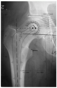 Why Polished Tapered Cemented Stems Excel in Hip Replacement