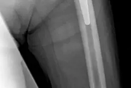 صورة توضيحية لـ جراحة مراجعة مفصل الورك: حلول لتحديات إعادة بناء الحق الحقي بعد استبدال المفصل على مرحلتين