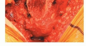 Illustration 13 for Uncemented THA: Critical Soft Tissue Tension for Joint Stability