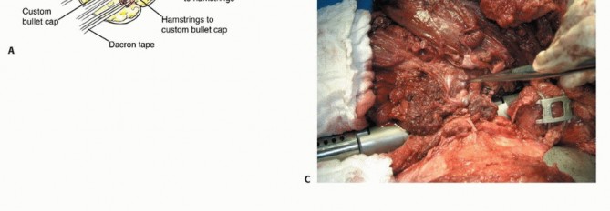 صورة طبية: استئصال مفصل الورك: دليل شامل للمرضى مع الأستاذ الدكتور محمد هطيف