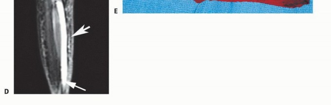 صورة طبية: استئصال ورم العضلة النعلية: دليل شامل لحماية عضلة الساق والتعافي الكامل في صنعاء مع الأستاذ الدكتور محمد هطيف