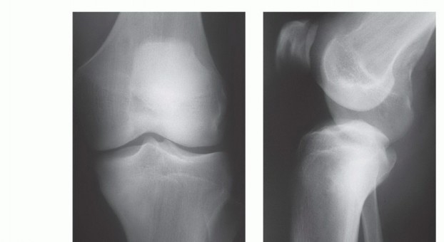 صورة طبية: معالجة الأورام المعقدة في قصبة الساق القريبة حلول الحفاظ على الأطراف
