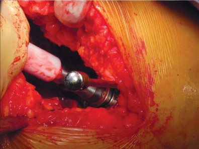 صورة طبية: تقنية الجذع القصير لاستبدال مفصل الورك الكلي: نهج الأستاذ الدكتور محمد هطيف لتدخل جراحي أقل ونتائج أفضل