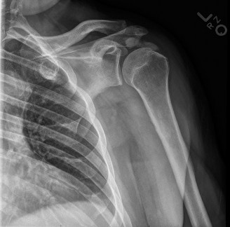 Illustration 54 for Right Shoulder Pain? Avoid This Common X-ray Mistake.