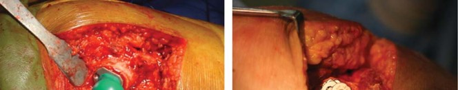 صورة طبية: مفصل الفخذ الصناعي قصير الجذع METHA: حلول مبتكرة للحفاظ على العظم في صنعاء مع الأستاذ الدكتور محمد هطيف