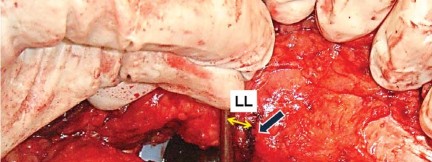 Illustration 27 for Mastering Soft Tissue Balancing for Optimal THR Outcomes