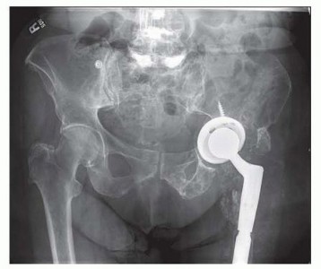 Illustration 2 for Pelvic Discontinuity: Understanding Superior and Inferior Separation