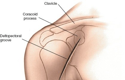 Illustration 8 for Essential Guide: Mastering Every Approach to the Shoulder